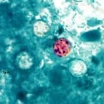 Cyclosporiasis Cases Confirmed in Baxter County, Statewide Numbers Rise